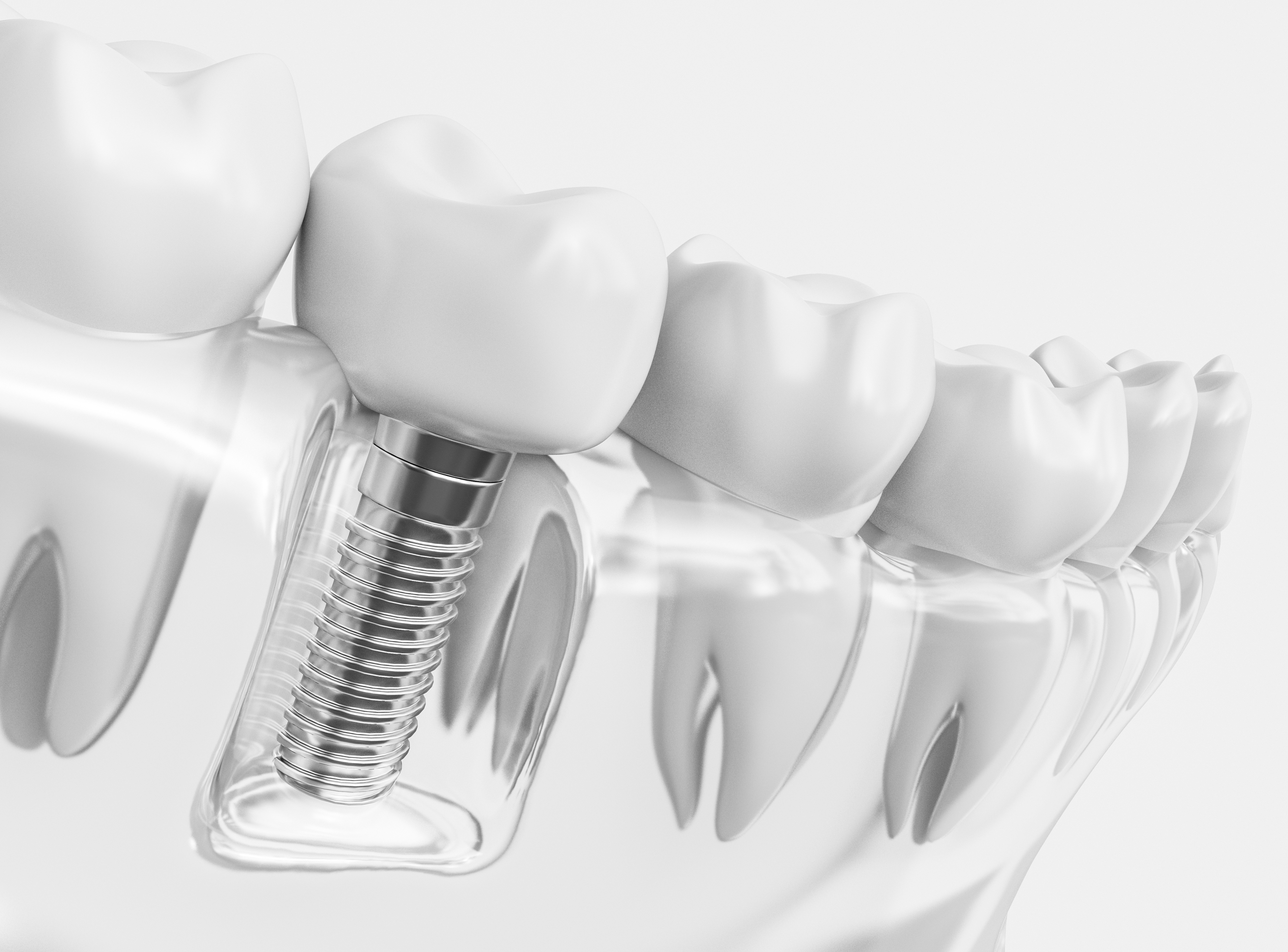 Tooth human implant - 3D Rendering