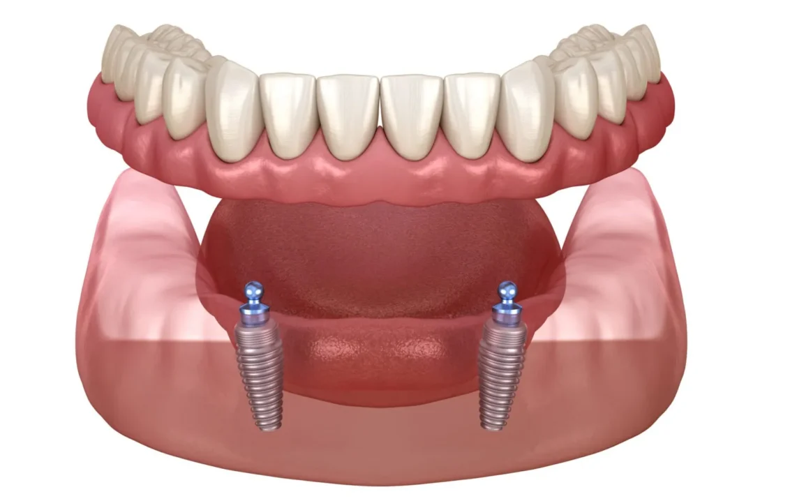 Implants-for-Dentures