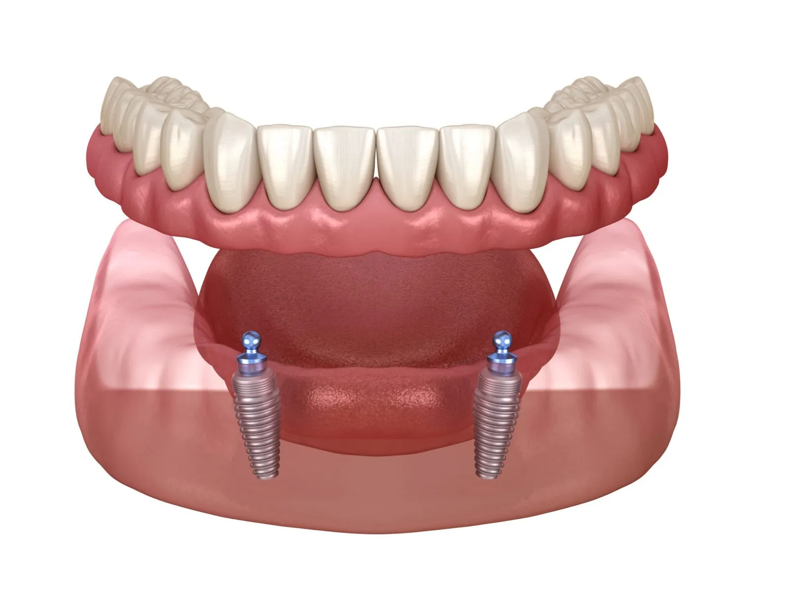 Implants-for-Dentures
