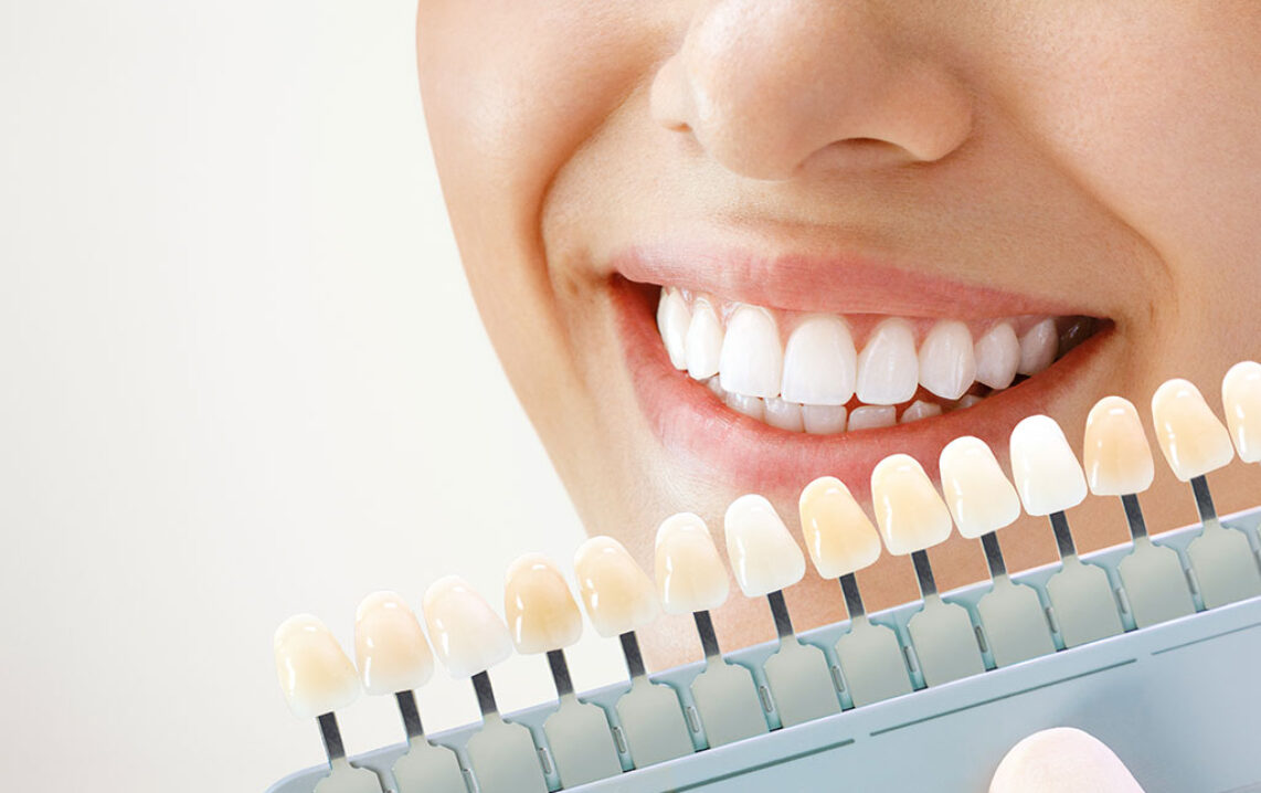 Safe and Effective Teeth Whitening: Comprehensive Guide
