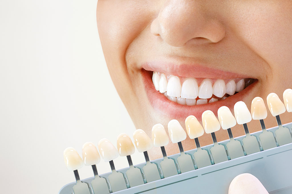 Safe and Effective Teeth Whitening: Comprehensive Guide