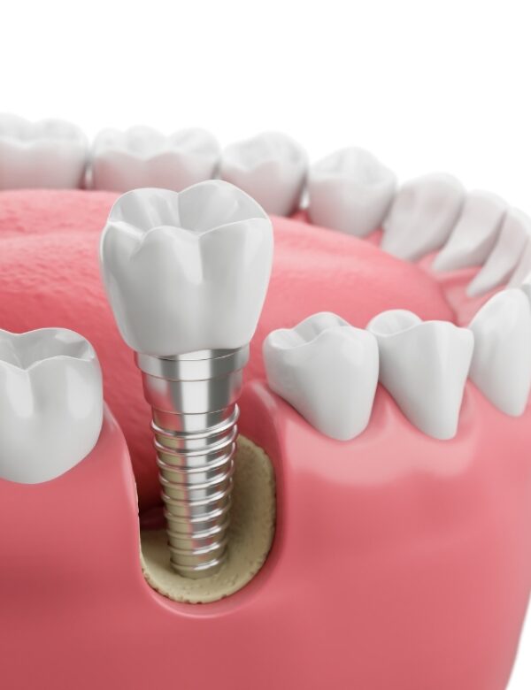 Dental implants
