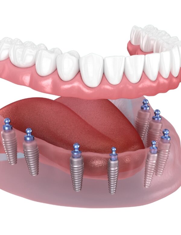 Implant retained dentures