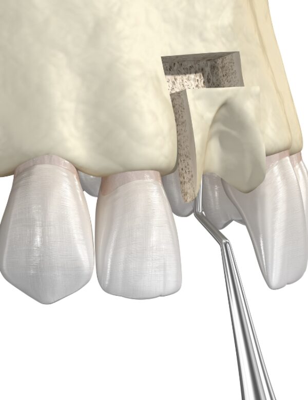 L-PRF Bone Grafting for Dental Implants