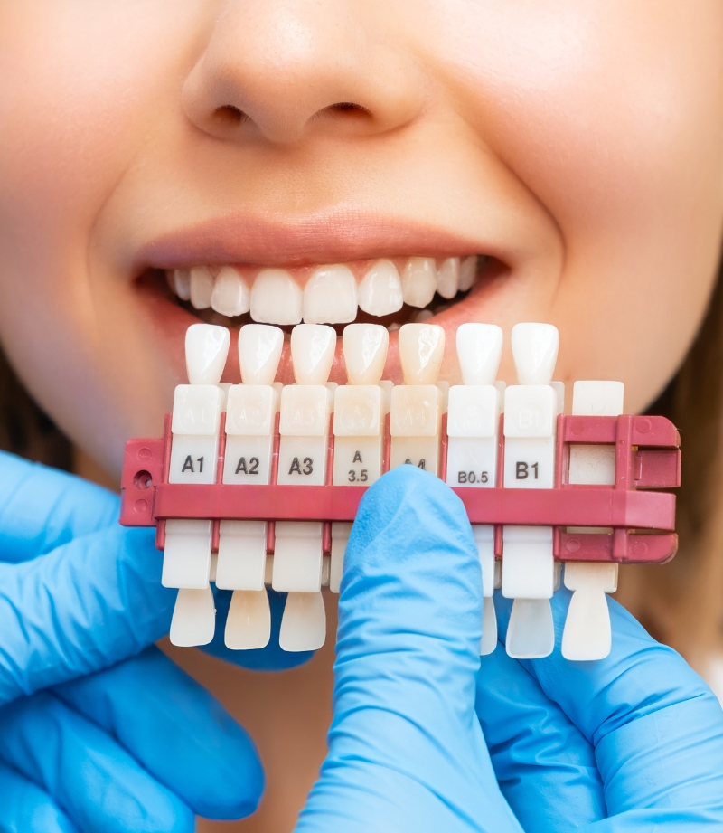 Teeth Whitening