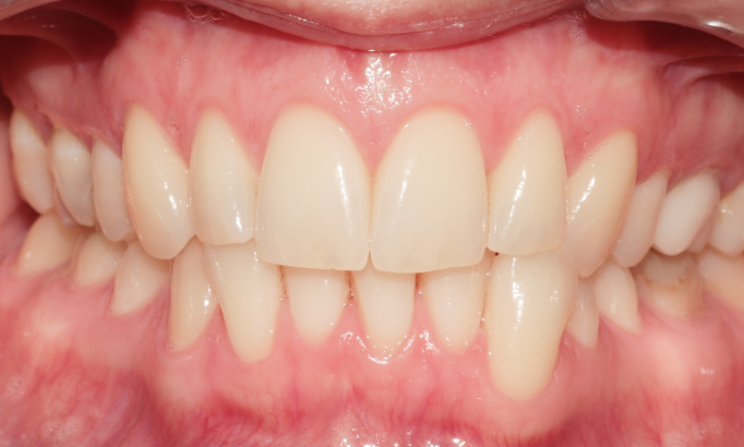 Teeth Alignment - Case 1 before