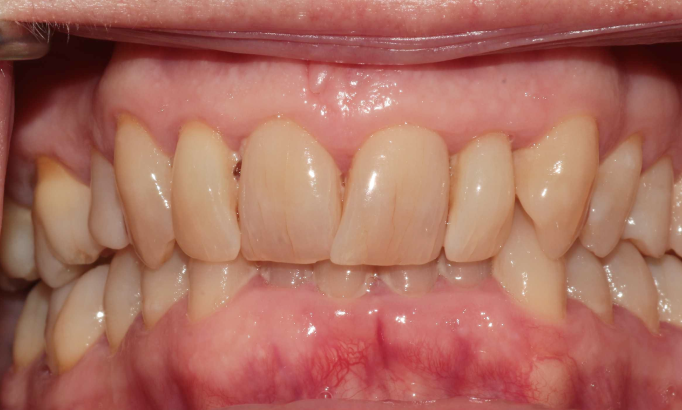 Teeth Alignment - Case 5 before