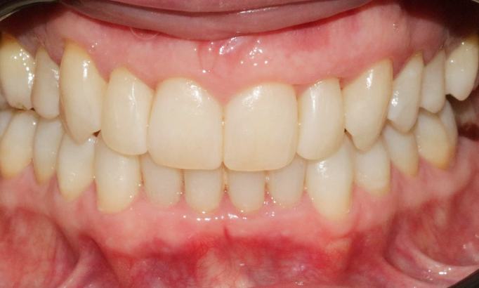 Teeth Alignment - Case 5 after