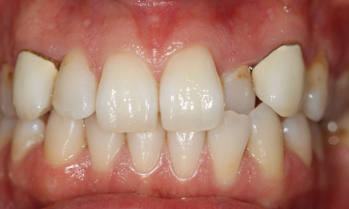 Teeth Alignment - Case 6 before