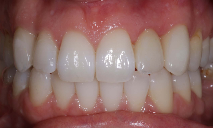 Teeth Alignment - Case 6 after