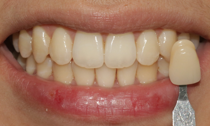 Teeth Whitening - Case 1 before