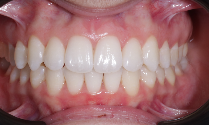 Teeth Alignment - Case 7 after