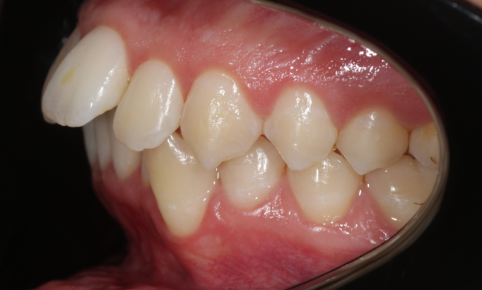 Teeth Alignment - Case 8 before