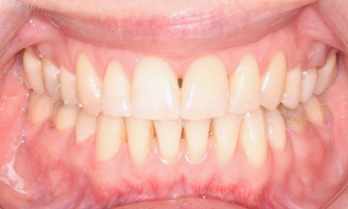 Teeth Alignment - Case 1 after