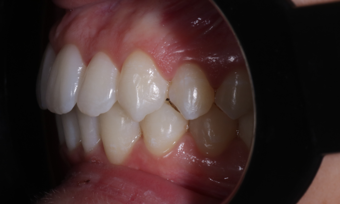 Teeth Alignment - Case 8 after