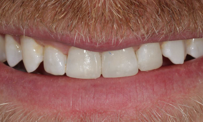 Composite Bonding - Case 1 after