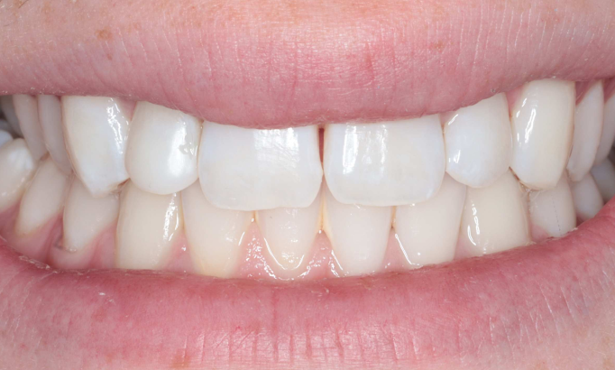 Composite Bonding - Case 2 after