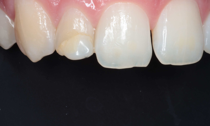 Composite Bonding - Case 3 before