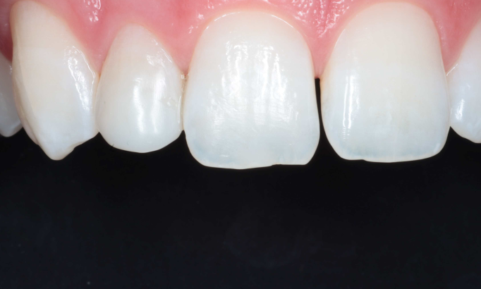 Composite Bonding - Case 3 after