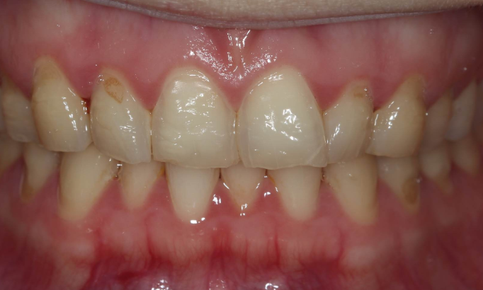 Composite Bonding - Case 4 before