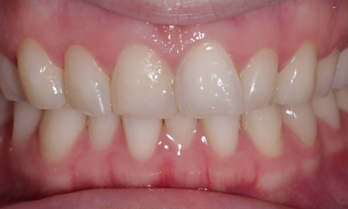 Composite Bonding - Case 4 after