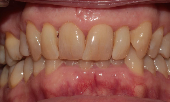 Composite Bonding - Case 6 before