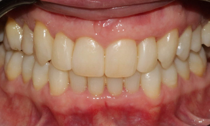 Composite Bonding - Case 6 after