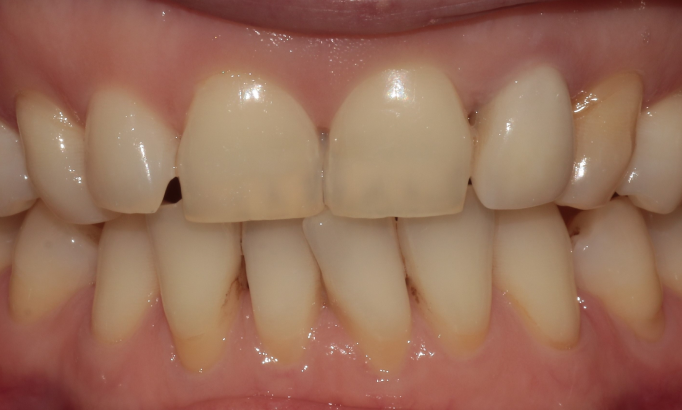 Composite Bonding - Case 7 before