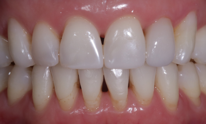 Composite Bonding - Case 7 after