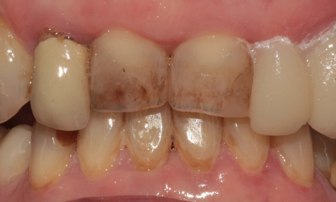 Composite Bonding - Case 8 before