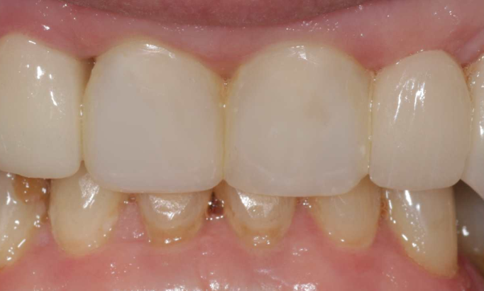 Composite Bonding - Case 8 after