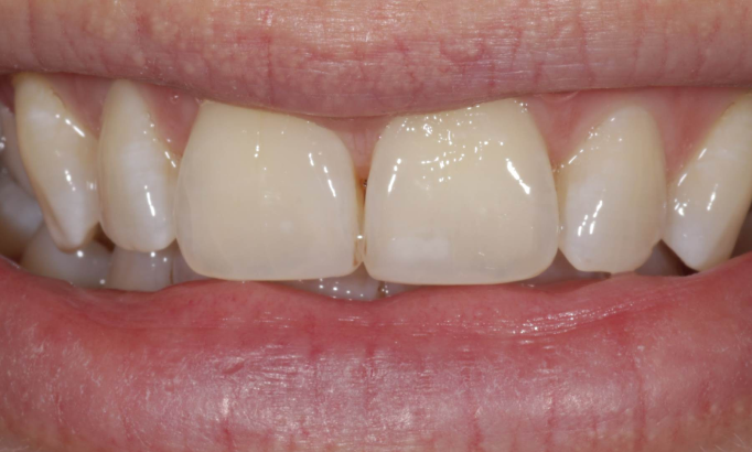 Composite Bonding - Case 9 after