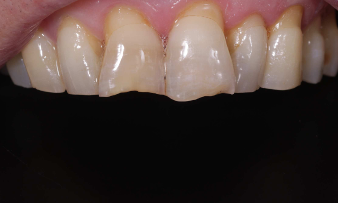 Composite Bonding - Case 10 before
