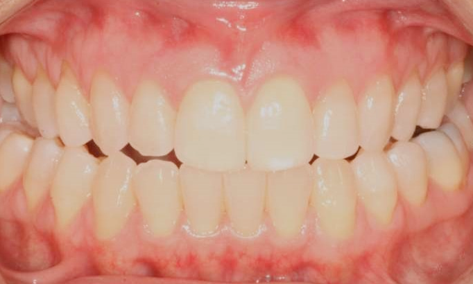 Teeth Alignment - Case 2 after