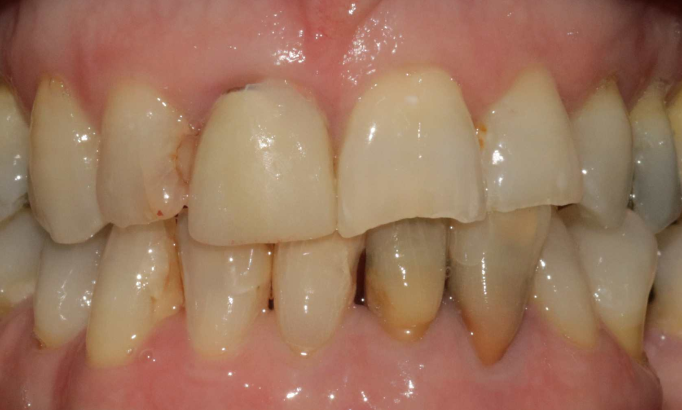 Composite Bonding - Case 11 before