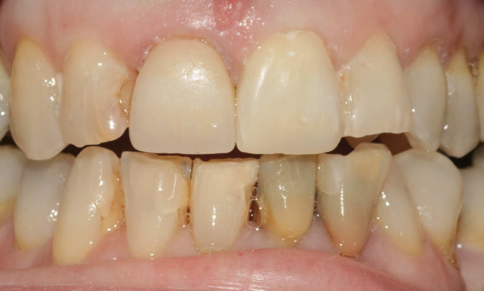 Composite Bonding - Case 11 after
