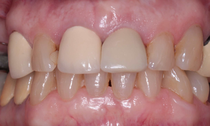 Crowns and bridges - Case 1 before