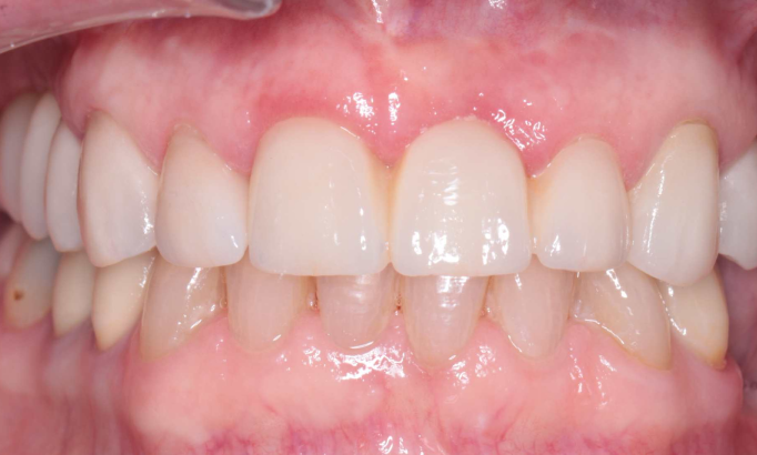 Crowns and bridges - Case 1 after