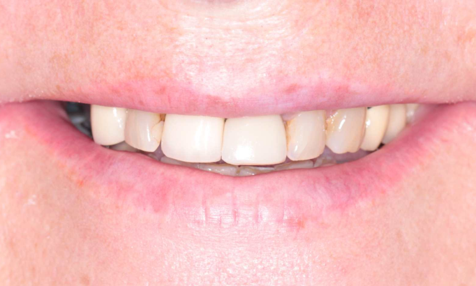 Crowns and bridges - Case 2 before