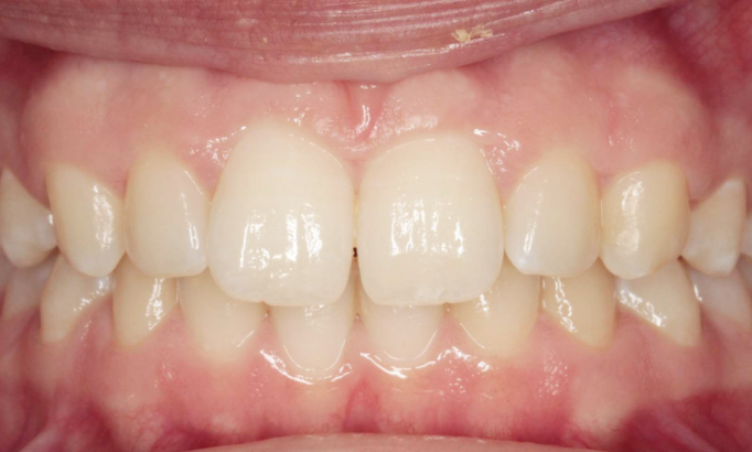 Teeth Alignment - Case 3 before