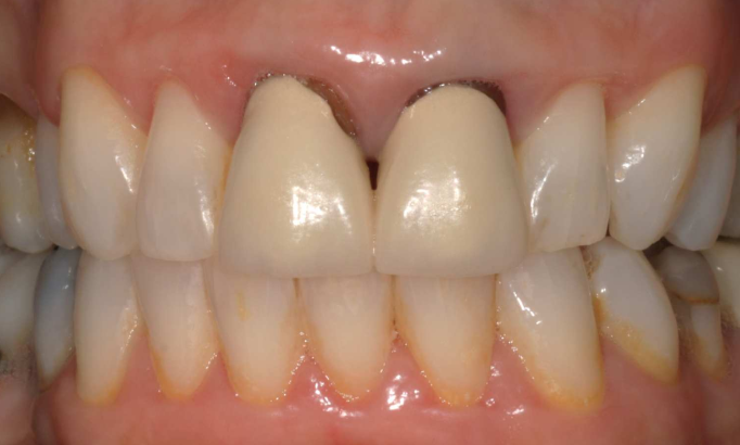 Crowns and bridges - Case 3 before