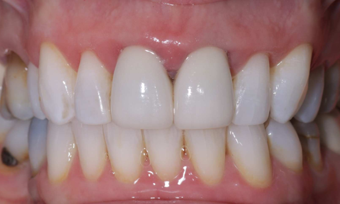 Crowns and bridges - Case 3 after