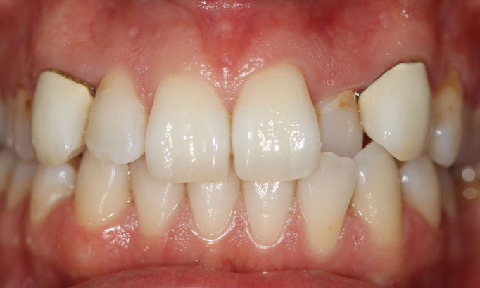 Crowns and bridges - Case 4 before