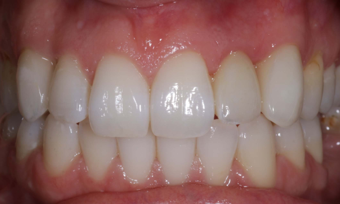 Crowns and bridges - Case 4 after