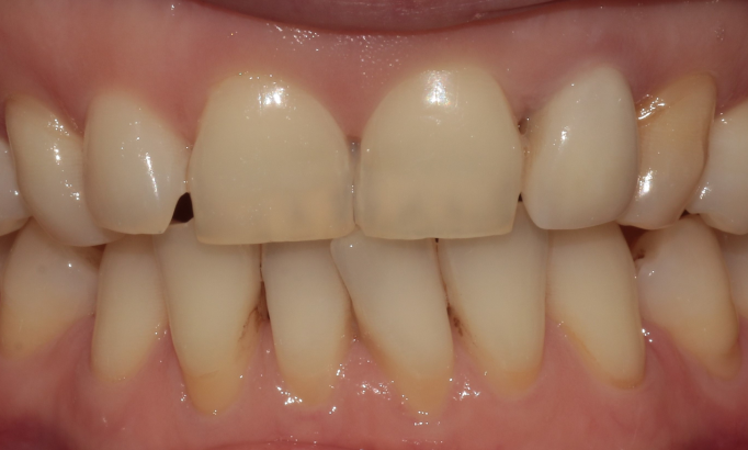 Crowns and bridges - Case 5 before