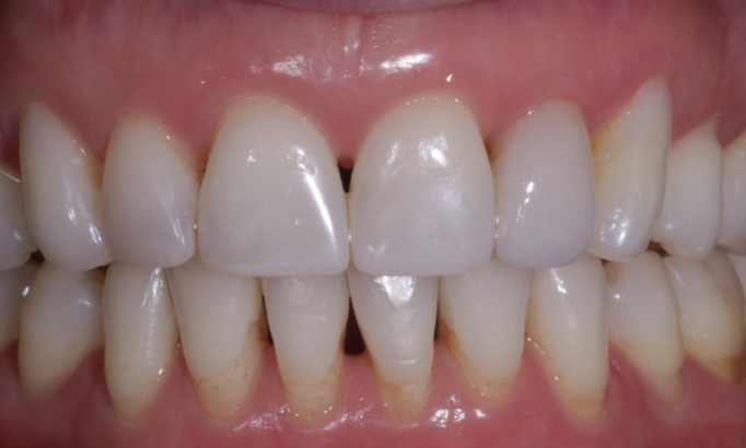 Crowns and bridges - Case 5 after