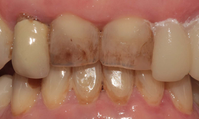 Crowns and bridges - Case 6 before