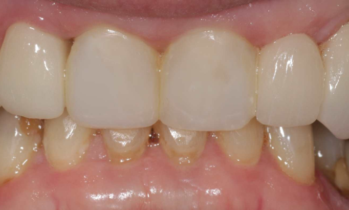 Crowns and bridges - Case 6 after