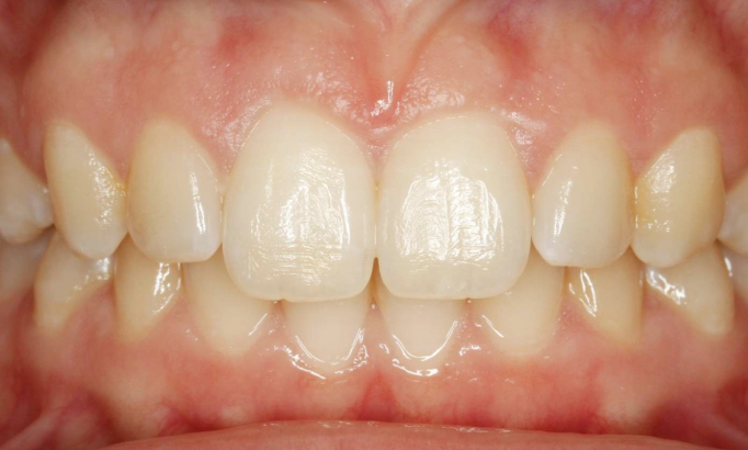 Teeth Alignment - Case 3 after