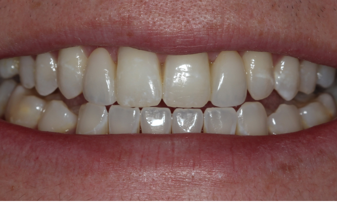 Crowns and bridges - Case 7 after